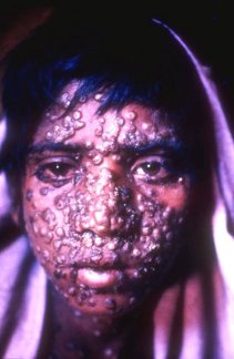 15歳少年、インド(1975)(国立感染研究所 倉田 毅 博士提供)
